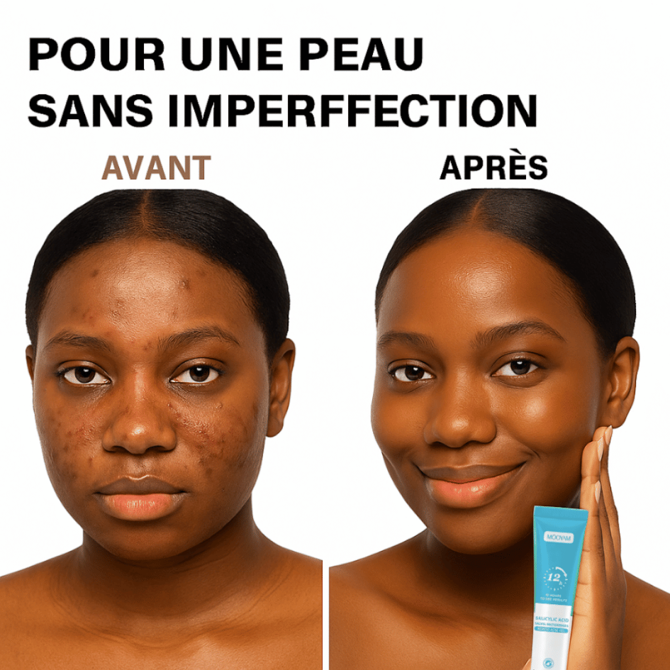 Gel Anti-Acné MOOYAM | Résultats visibles en 12h
